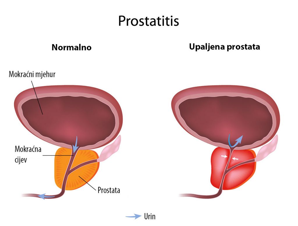 Una de las técnicas más eficaces para tratar la prostatitis